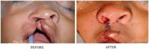 Cleft Lip & Palate Oral Surgeon, San Francisco, California