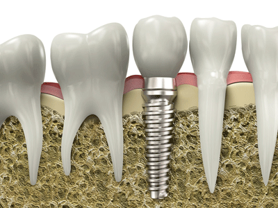 Bone Grafting Oral Surgeon